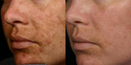 Since Melasma is Best Treated with Hydroquinone Cream, What is the Strongest Stength That Can Be Purchased with a Pre...