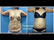 (Tummy Tuck Surgery )Abdominoplasty in Punjab, Chandigarh - TIPS Institute