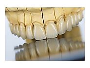 Porcelain Fused to Metal Crown: Key Things You Should Know about PFM Restoration