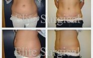 Abdominoplasty or Tummy Tuck Surgery at Elite Surgical