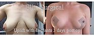 Breast Uplift (Mastopexy) Surgery at Elite Surgical