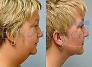 Chin and Cheek Reshaping at Elite Surgical