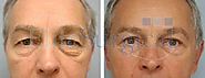 Eye Bag Removal & Upper Eyelid Surgery at Elite Surgical