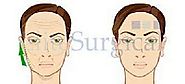 Facelift Treatments – One Stitch Lift, Thread Lift at Elite Surgical
