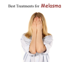 Top five Best Treatments for Melasma