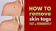 How to Remove Skin Tags at Home Fast and Permanently