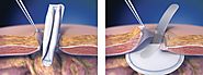 Umbilical Ventral Hernia | Laparoscopic Hernia Repair Surgery Dubai
