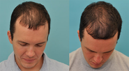 ACell Hair Regrowth Injection Therapy - Texas