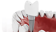 Where You can get Cheap Dental Implants Melbourne?
