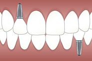 GET YOUR DENTAL IMPLANT, AND SMILE BETTER! - Ezcadlab's soup