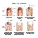 Root Canal Dentist Ca