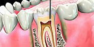 When do you need a root canal treatment?