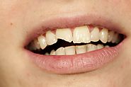 Cracked Or Chipped Front Tooth – What Can You Do?