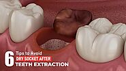 6 Tips to Avoid Dry Socket After Teeth Extraction | Dental Blog