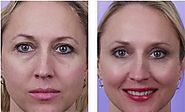 Is time you considered Eyelid Surgery to improve your countenance?