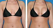Choosing the right type of breast implants for breast augmentation