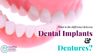 Difference Between Dental Implants and Dentures | Healthy Smiles