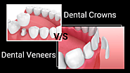 What is the Difference Between Dental Crowns and Dental Veneers?