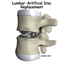 Artificial Disc Replacement - A Complete Overview