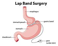 Lap Band Surgery Dallas