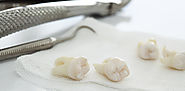 Get all the Wisdom teeth issues cleared with Wisdom teeth removal Melbourne