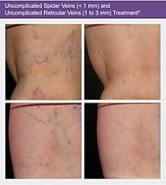 Spider Veins Treatment | Sclerotherapy For Spider Veins in Northern VA