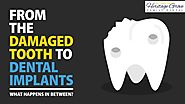 The Damaged Tooth To Dental Implants: Dental Implants Plainfield IL #Dental #Dentist #Dentalimplant