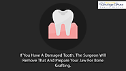 Dental Implants Image - 4