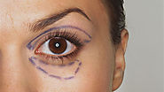 Eyelid Surgery and Its Significance - Dr. Debraj Shome