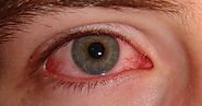 Red Eyes – Causes and Treatment - Dr. Debraj Shome