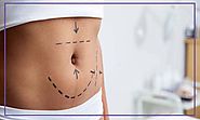 Lipomatik (Güldüren, Gıdıklayan) Liposuction Nedir? – BinterPlast – Prof.DR. Mübin Hoşnuter