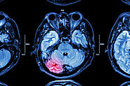 Website at http://www.neurosurgerynow.com/skull-base-tumors.html