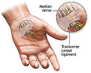 Carpal Tunnel Syndrome Treatment in Hyderabad | Wrist Pain Surgery