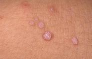 Know the Three Dangerous Methods in Common Practice for Wart Removal
