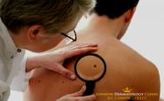 Get The Best Treatment For Skin Lesions At The London Dermatology Clinic