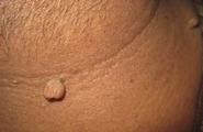 Skin Tag Elimination: Three Practiced Medical Practitioners