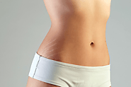12 ways Get Rid of Stretch Marks Naturally - Healthhunt.in