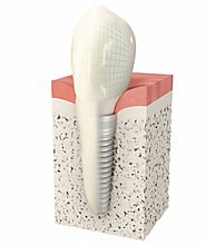 Know The Best Tooth Implant Treatments