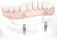 High-Quality Denture Implants Service At Affordable Cost