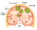 Intraventricular Tumor Treatment | Radiation Therapy Noida