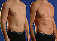 Top 5 Benefits of Gynecomastia Surgery for Male - hairnhair.over-blog.com