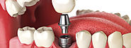 Website at https://www.skncosmetics.com/blog/dental-implants-cost-in-islamabad/