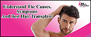 Understand The Causes, Symptoms and Best Hair Transplant | Med Advisors