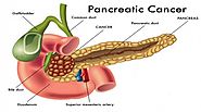 Laparoscopic Pancreatic Cancer Surgery kerala | Pancreatic Cancer Treatment Kochi