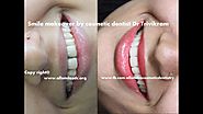 Best Cosmetic Dentist in Bangalore | Tooth Discoloration Treatment India