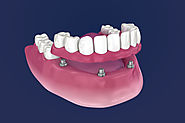 Implant Supported Dentures | Fixed Teeth Implants Bangalore | India