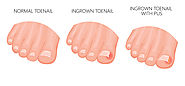 Ingrown Toe Nail Removal BTM Layout, Bangalore | Nail Diseases Treatment India