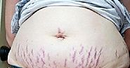 Stretch Marks Removal With Effective Laser Treatments in Dubai
