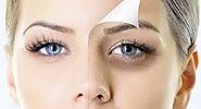 What Causes Dark Circles Under the Eyes and How to Get Rid of Them? - dubailasertreatmentss.over-blog.com