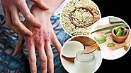 Eczema Herbal Treatment, Symptoms, Causes - Natural Herbs Clinic